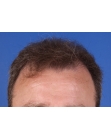Before Hair Transplant &nbsp;Front